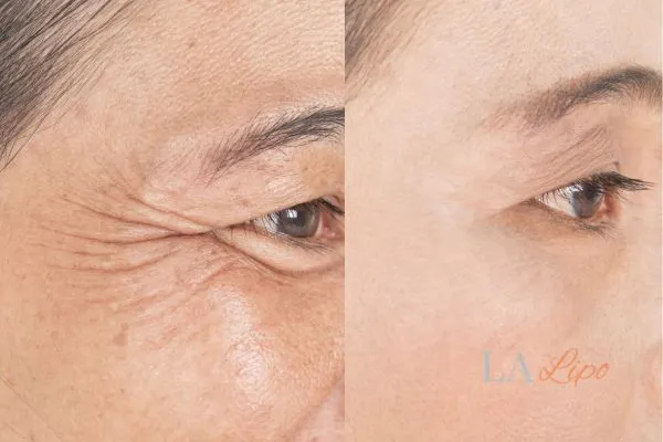 Before and after results of woman - HI-fu wrinkles reduction treatment Owsestry