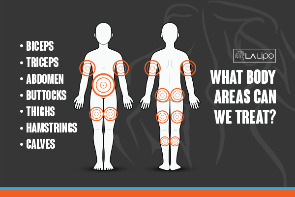 Graphic to show areas you can have LA-EMS Body Sculpting Owsestry treatment.