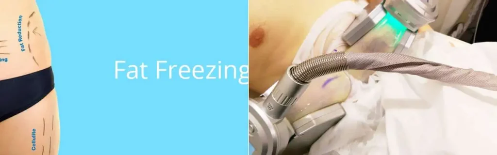 multi areas of a persons body having coolsculpting Owsestry treatment